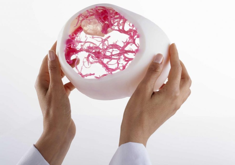 PolyJet support hematoma