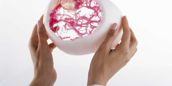 PolyJet support hematoma